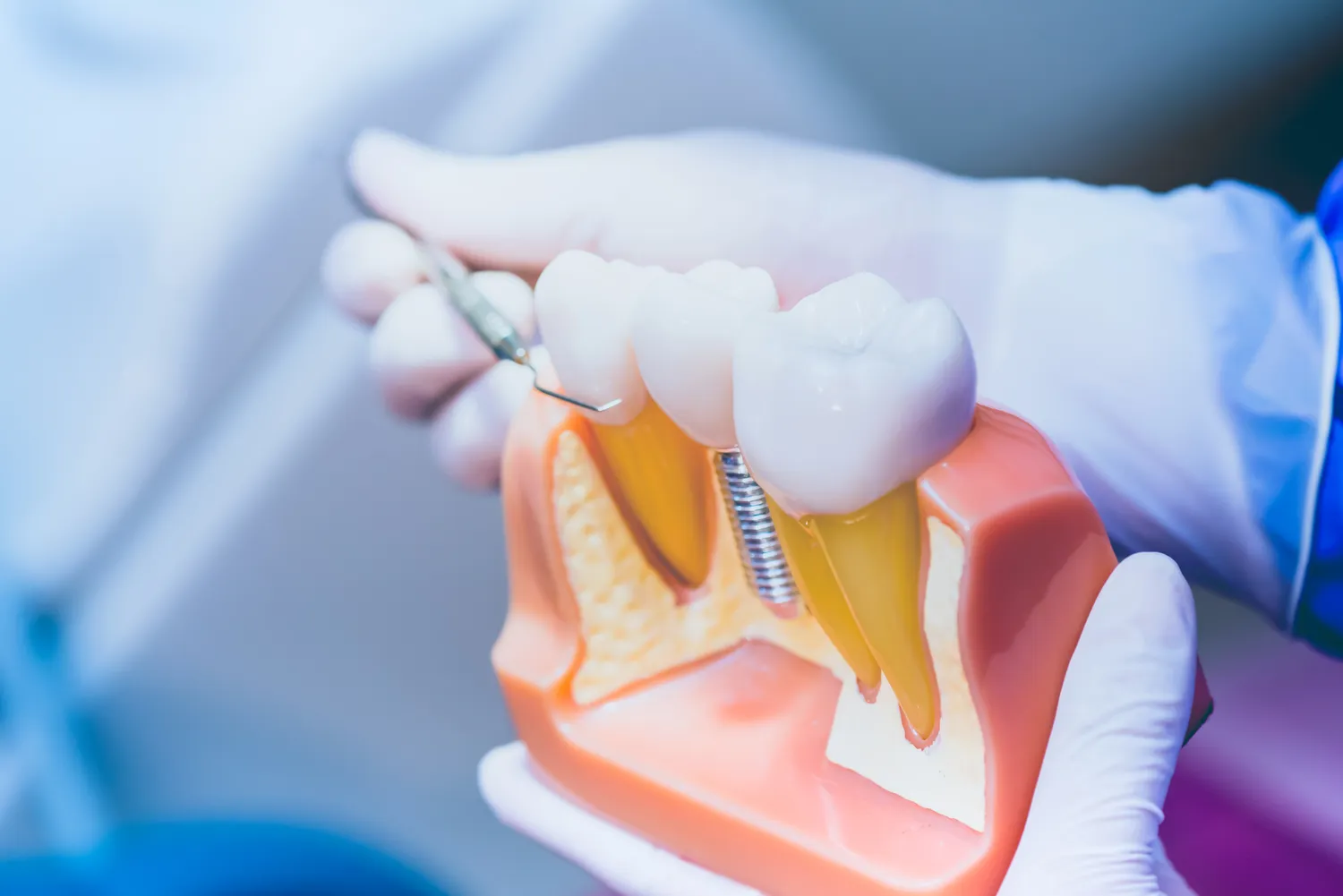 Cena implantu zęba Warszawa