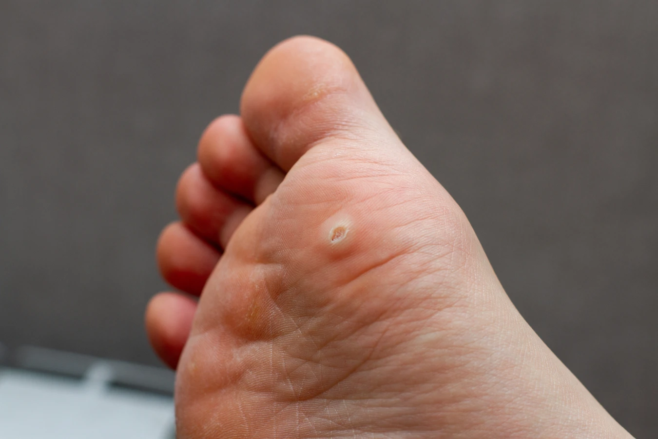 Ile kosztuje usunięcie kurzajki u dermatologa?