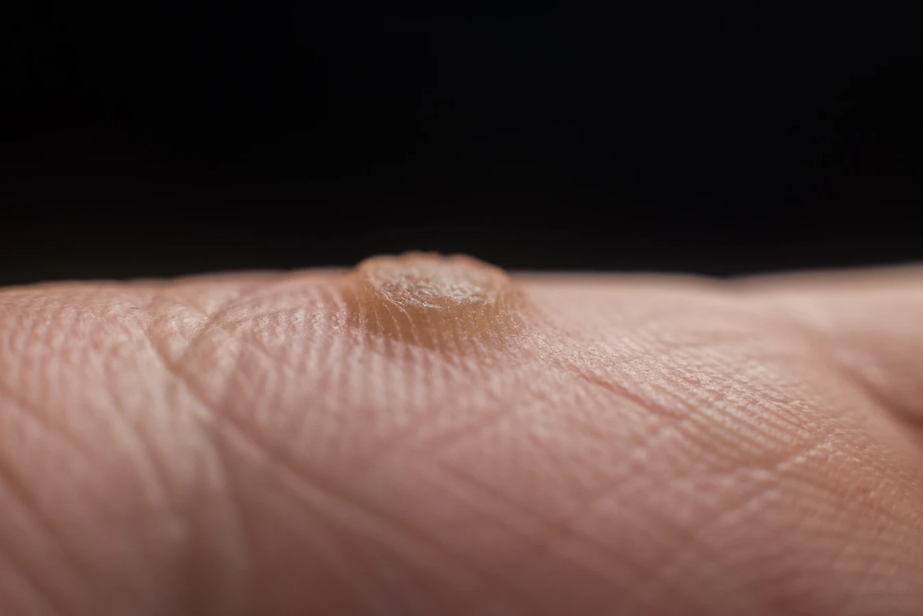 Co najlepiej stosować na kurzajki?