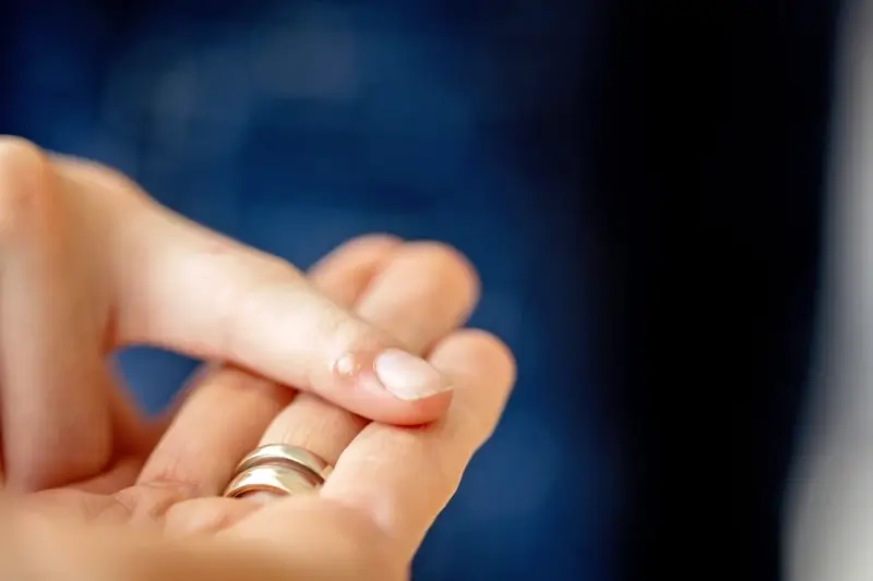 Czy kurzajką można się zarazić?